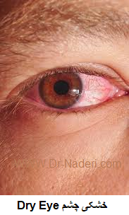 Dry Eye خشکی چشم